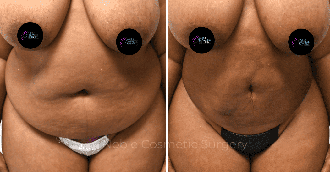 LIPOSUCTION-CASE-13371 | Before and After Liposuction