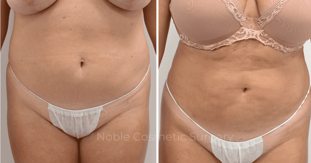 LIPOSUCTION-CASE-13006 | Before and After Liposuction