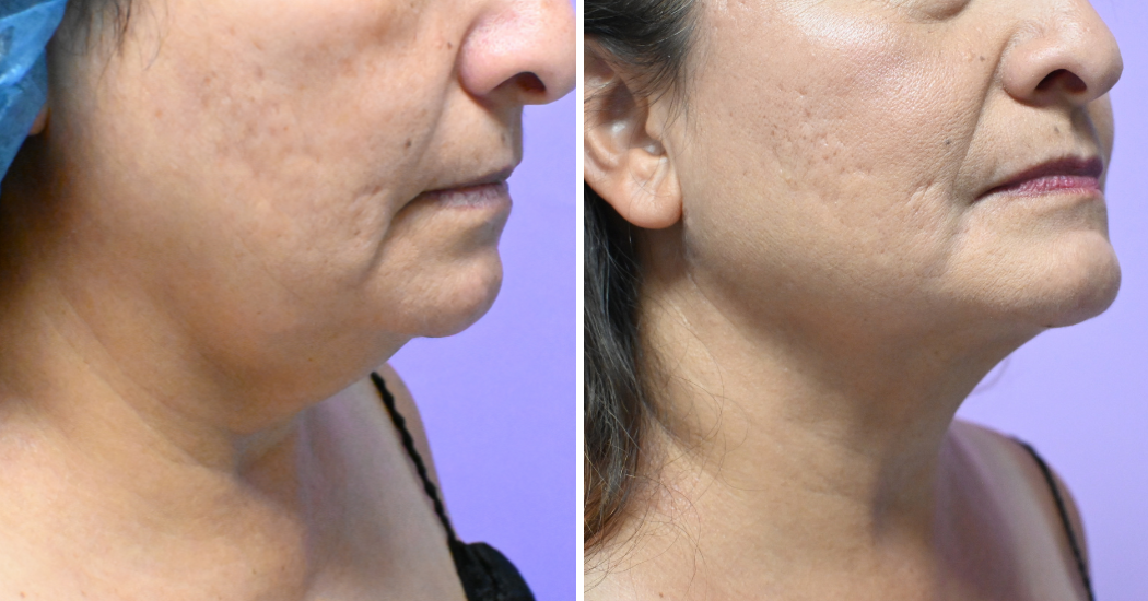 Case--19506 | Before and After Chin Liposuction