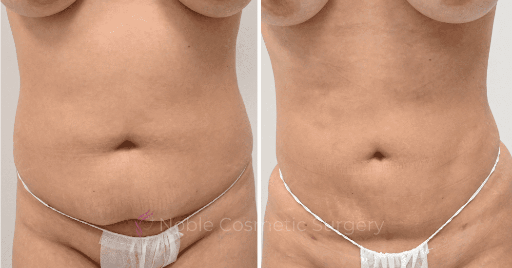 LIPOSUCTION-CASE-12977 | Before and After Liposuction