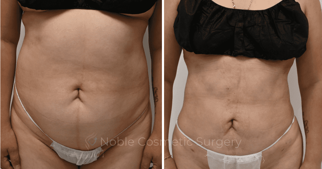 LIPOSUCTION-CASE-11116 | Before and After Liposuction