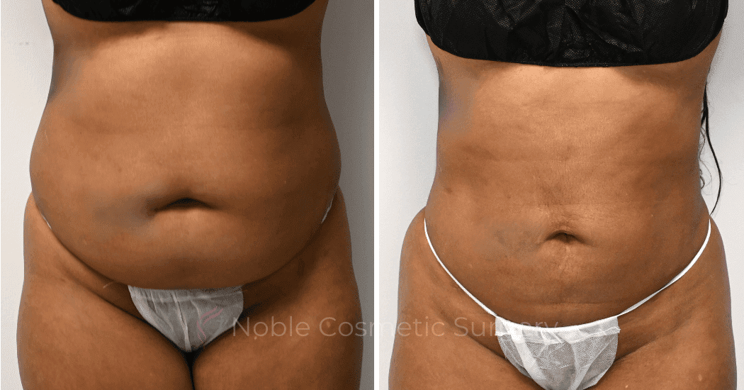 LIPOSUCTION-CASE-10929 | Before and After Liposuction