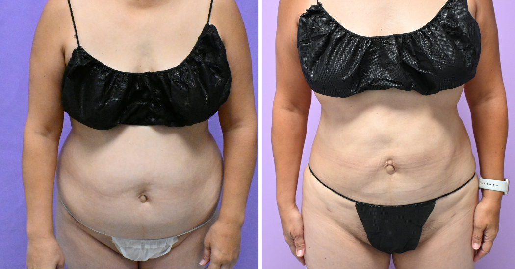 Case---19506 | Before and After Liposuction 1