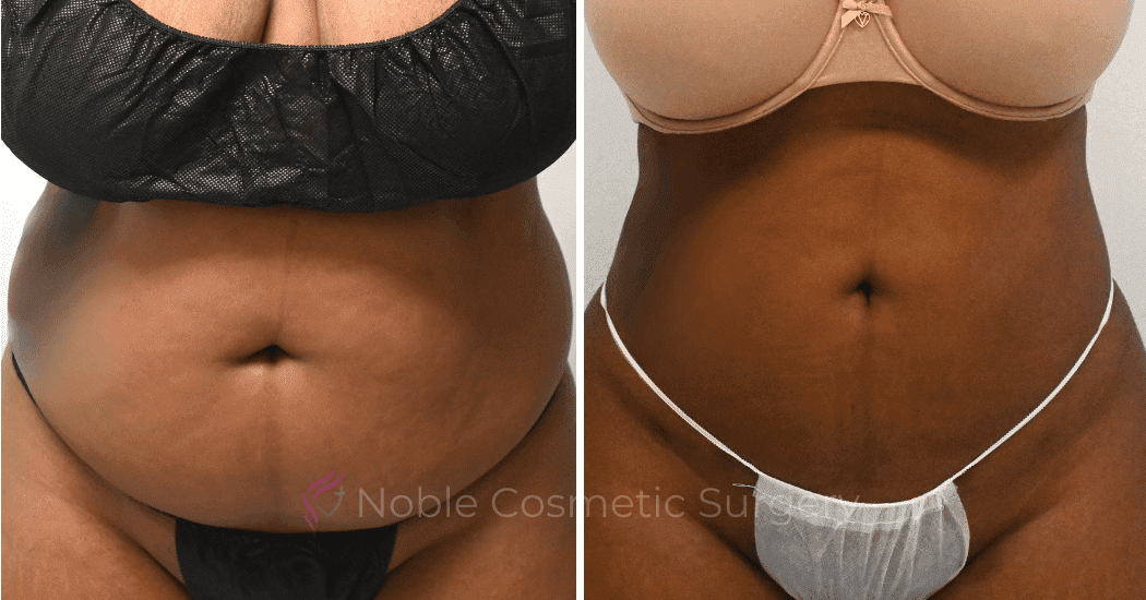 LIPOSUCTION-CASE-10271 | Before and After Liposuction