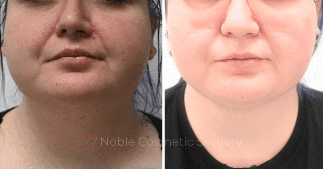 LIPOSUCTION-SUBMENTAL-CASE-19114 | Before and After Chin Liposuction