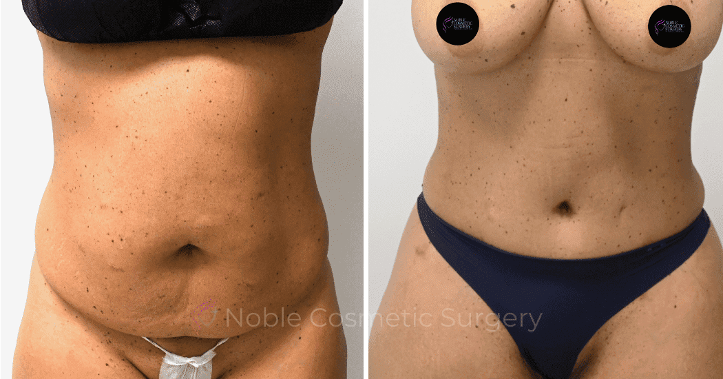 TUMMY-TUCK-CASE-10616 | Before and After Abdominoplasty