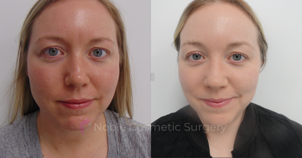 PICO-LASER-CASE-00005 | Before and After Pico Skin Rejuvenation
