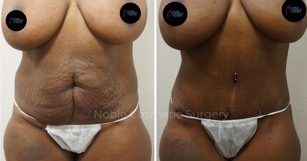 TUMMY-TUCK-CASE-00044 | Before and After Abdominoplasty 1