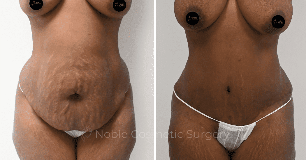 TUMMY-TUCK-CASE-10563 | Before and After Abdominoplasty