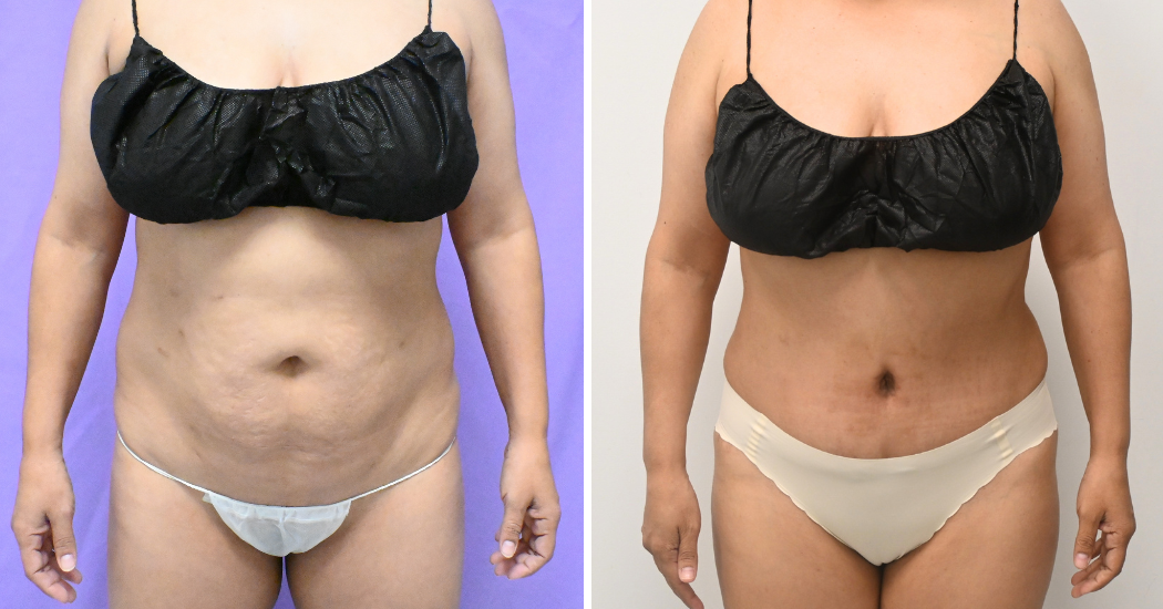 Case--20157 | Before and After Abdominoplasty 1