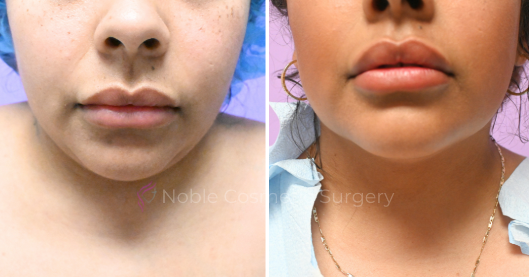Case--20274 | Before and After Chin Liposuction