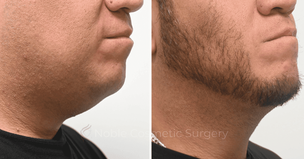 SUBMENTAL-LIPOSUCTION-CASE-19137 | Before and After Chin Liposuction 2