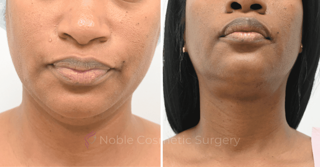 SUBMENTAL-LIPOSUCTION-CASE-12998 | Before and After Chin Liposuction