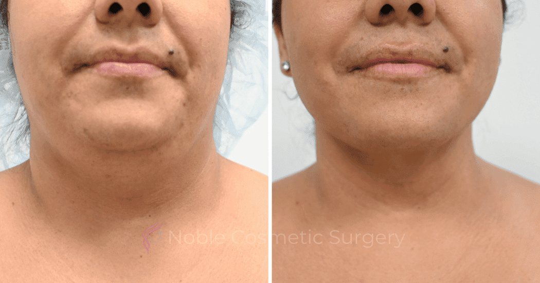 SUBMENTAL-LIPOSUCTION-CASE-12466 | Before and After Chin Liposuction