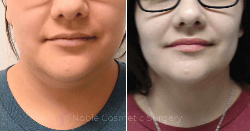 SUBMENTAL-LIPOSUCTION-CASE-10173 | Before and After Chin Liposuction