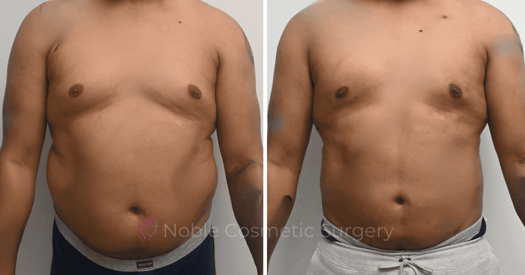 LIPOSUCTION-ABDOMEN-CASE-10135 | Before and After Male Liposuction