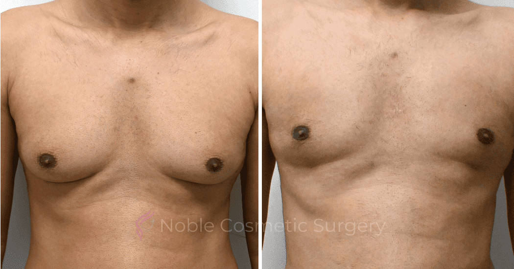 GYNECOMASTIA-CASE-10707 | Before and After Gynecomastia