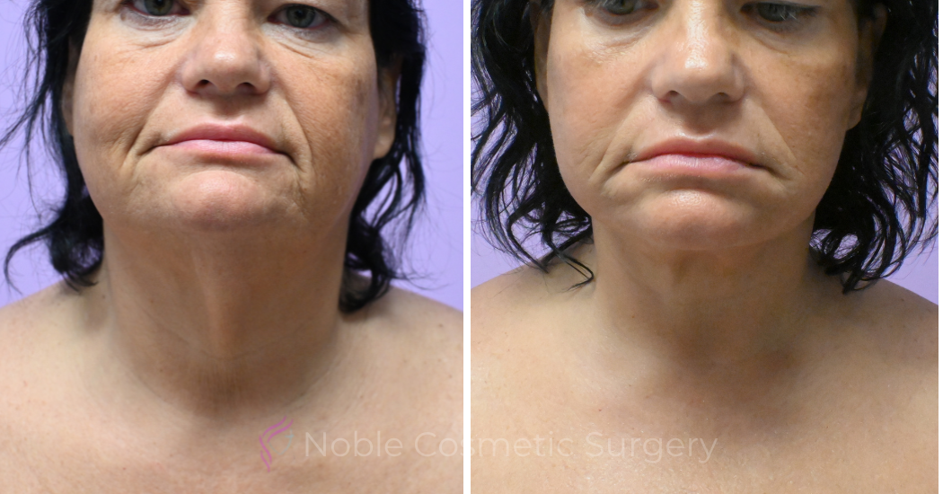 Case--5722 | Before and After Facelift