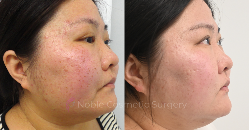 PICO-LASER-CASE-00006 | Before and After Pico Skin Rejuvenation