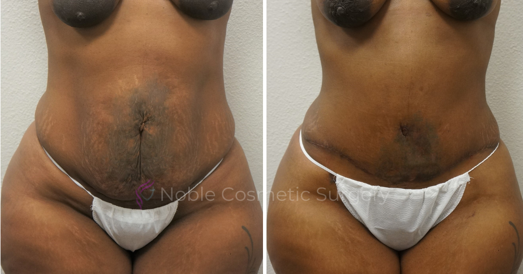 TUMMY-TUCK-CASE-00045 | Before and After Abdominoplasty 1