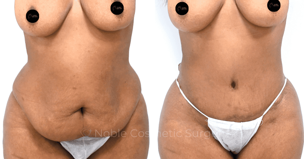 TUMMY-TUCK-CASE-13171 | Before and After Abdominoplasty