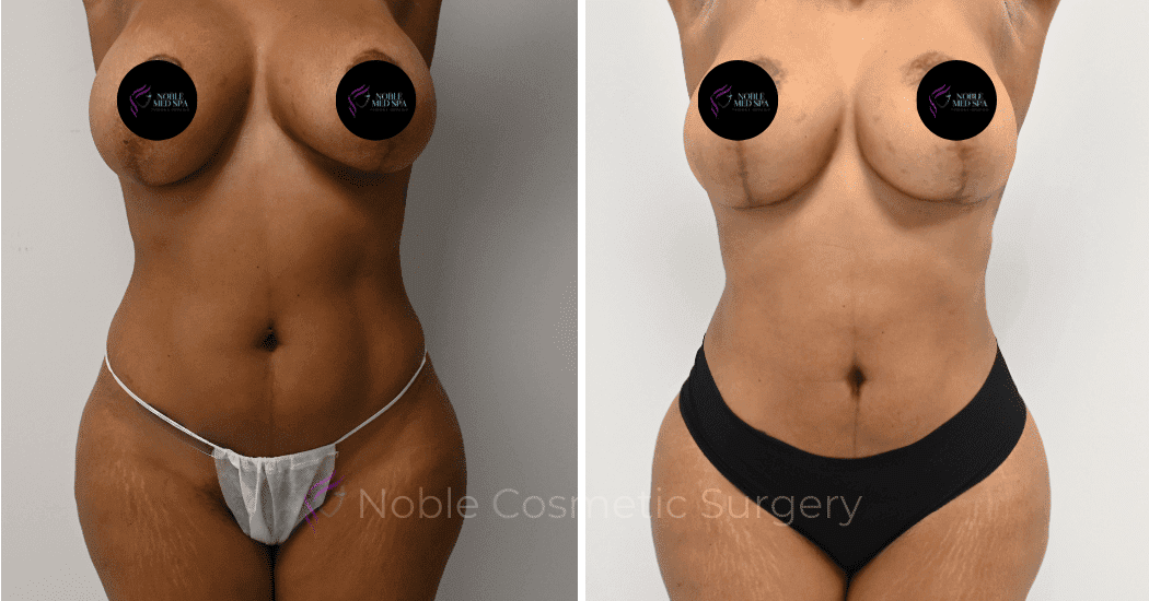 MOMMY-MAKEOVER-CASE-16458 | Before and After Mommy Makeover