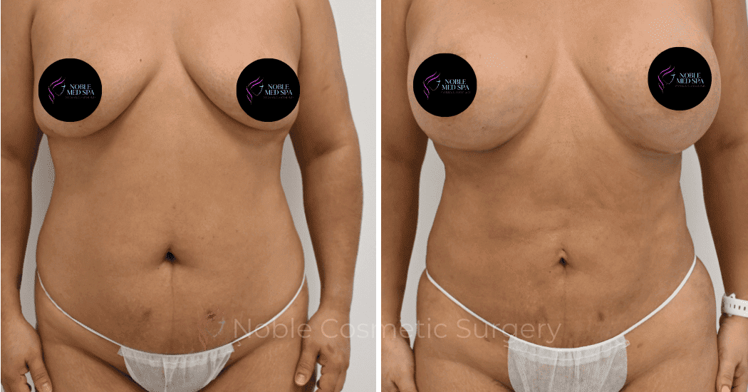 MOMMY-MAKEOVER-CASE-12466 | Before and After Mommy Makeover