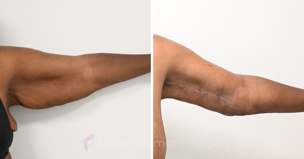 Case--20391 | Before and After Brachioplasty 2