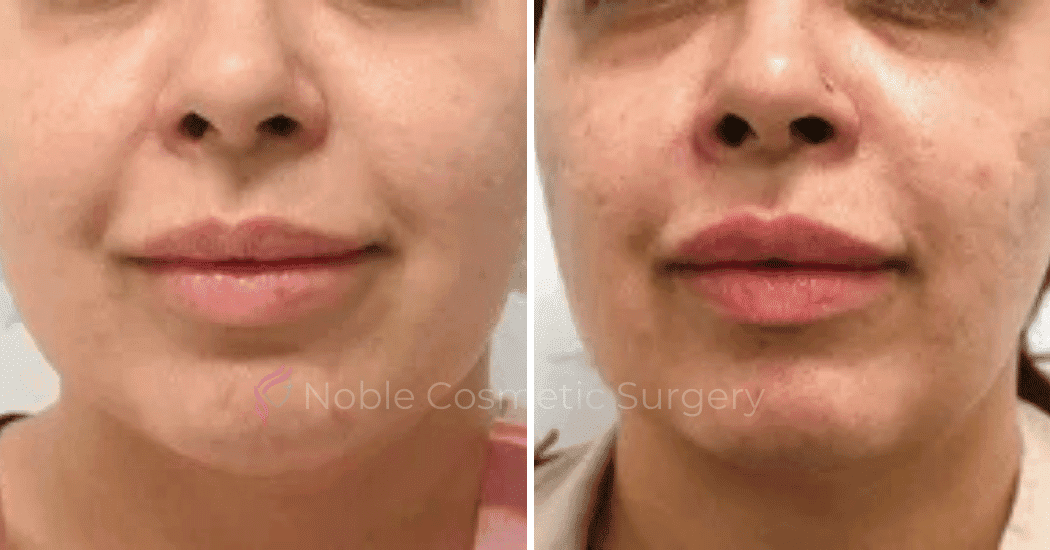 DERMAL-FILLERS-CASE-00259 | Before and After Dermal Fillers