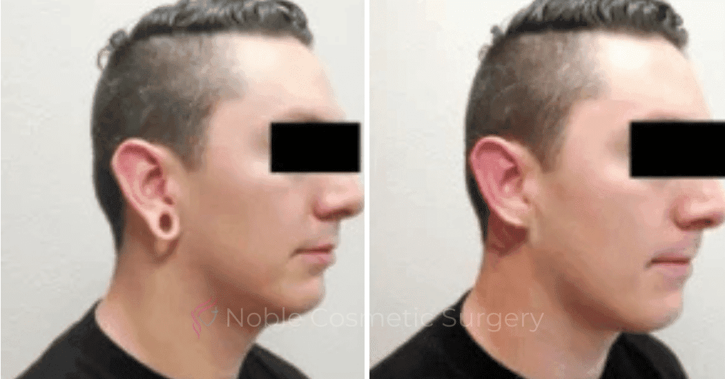Earlobe-Repair-Case-20254 | Before and After Earlobe Repair 2