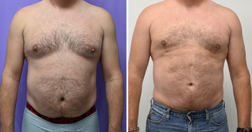 Case--13711 | Before and After Male Liposuction