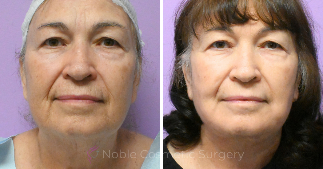 Case--20618 | Before and After Facelift