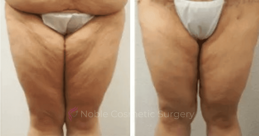 Thigh-Lift-Case-10386 | Before and After Thigh Lift
