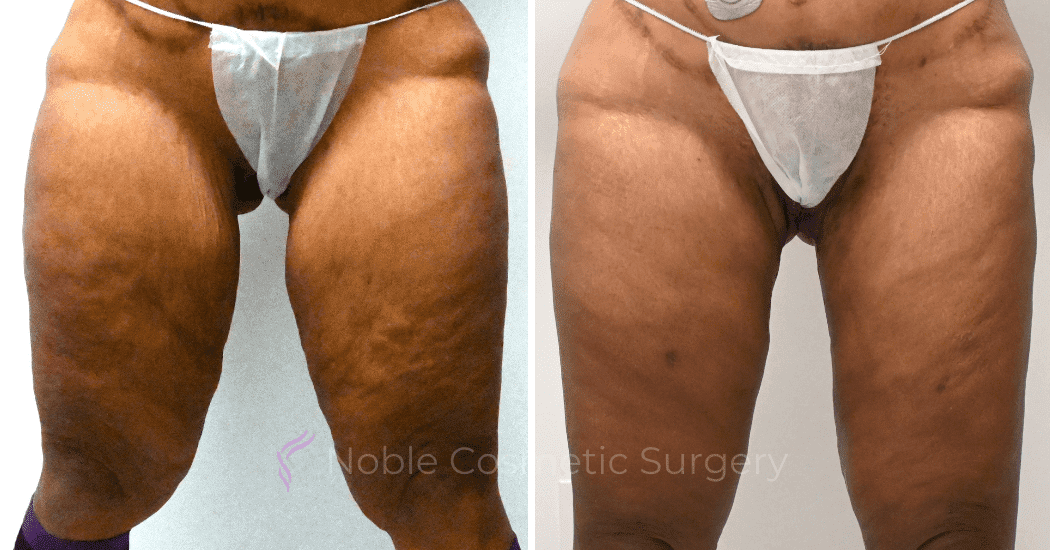 Thigh-Lift-Case-10384 | Before and After Thigh Lift