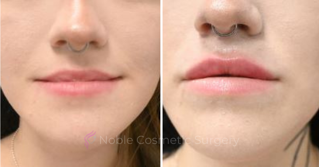 DERMAL-FILLERS-CASE-00265 | Before and After Dermal Fillers