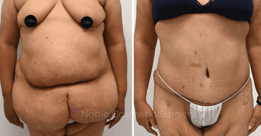 TUMMY-TUCK-CASE-12513 | Before and After Abdominoplasty