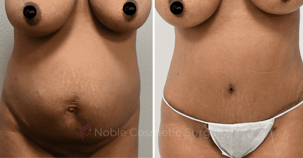 TUMMY-TUCK-CASE-14407 | Before and After Abdominoplasty