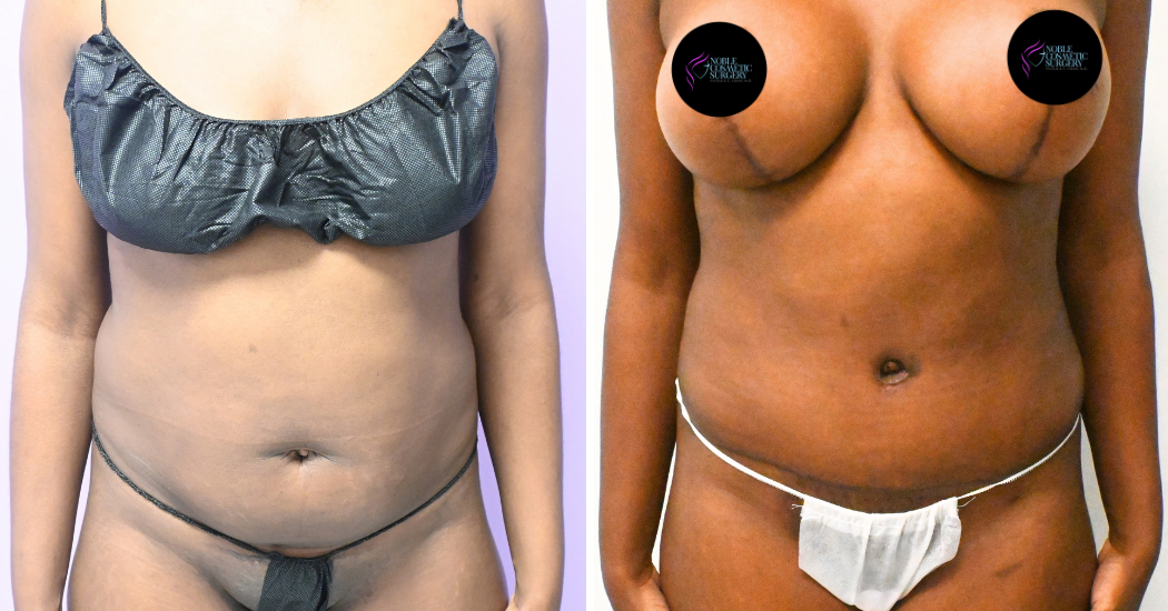 Case--20347 | Before and After Abdominoplasty 1