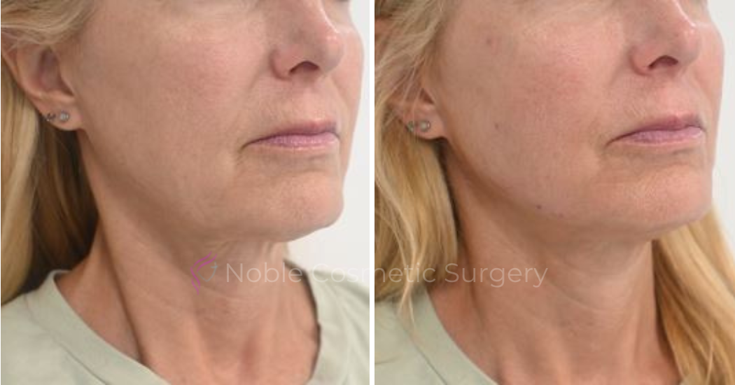 RF-MICRONEEDLING-CASE-00050 | Before and After RF Microneedling