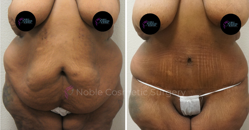 TUMMY-TUCK-CASE-00047 | Before and After Abdominoplasty 1