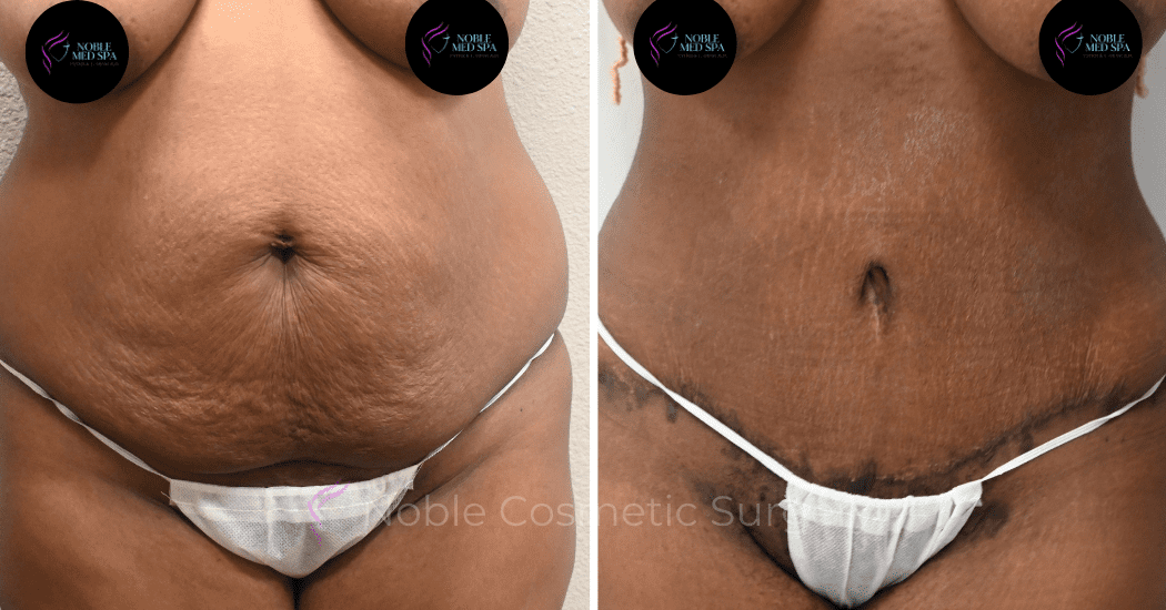 TUMMY-TUCK-CASE-13859 | Before and After Abdominoplasty