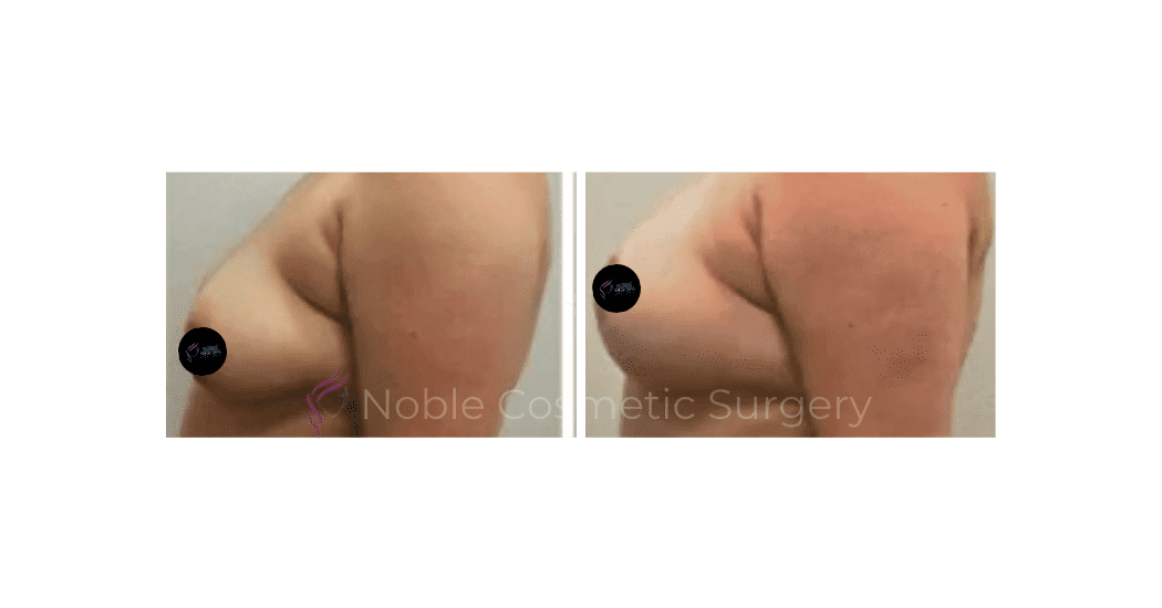 BREAST-LIFT-CASE-00510 | Before and After Breast Lift 3
