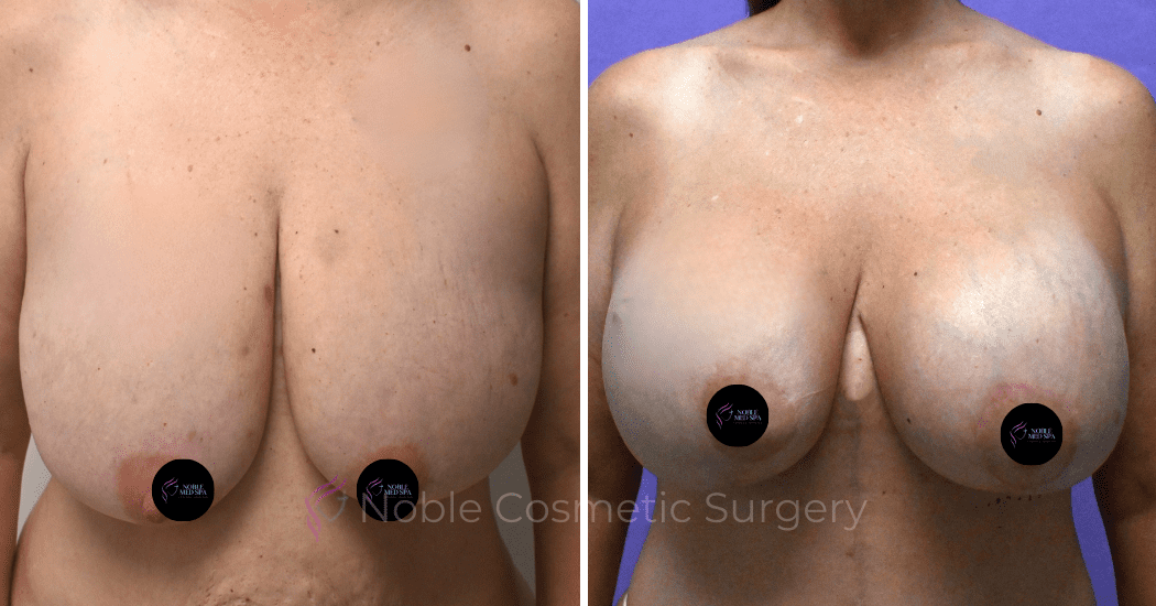 BREAST-AUGMENTATION-WITH-LIFT-CASE-10275 | Before and After Breast Augmentation with Lift