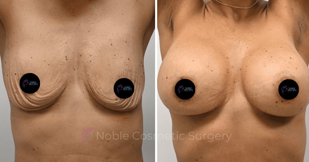 BREAST-AUGMENTATION-CASE-13021 | Before and After Breast Augmentation