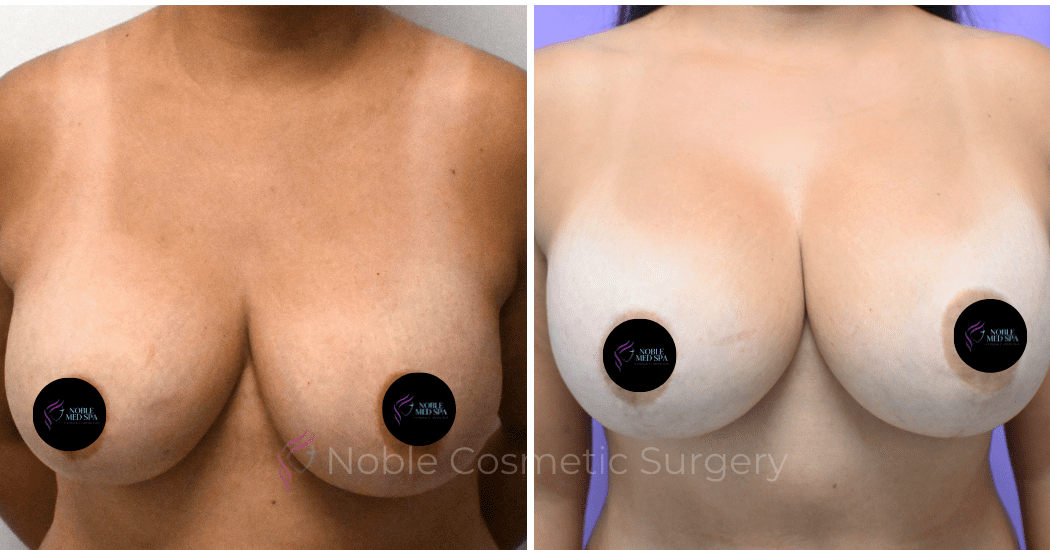 BREAST-AUGMENTATION--CASE-00310 | Before and After Breast Augmentation