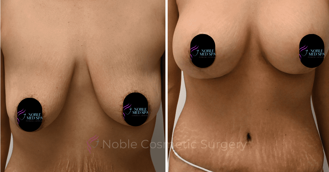 BREAST-AUGMENTATION-WITH-LIFT-CASE-10931 | Before and After Breast Augmentation with Lift