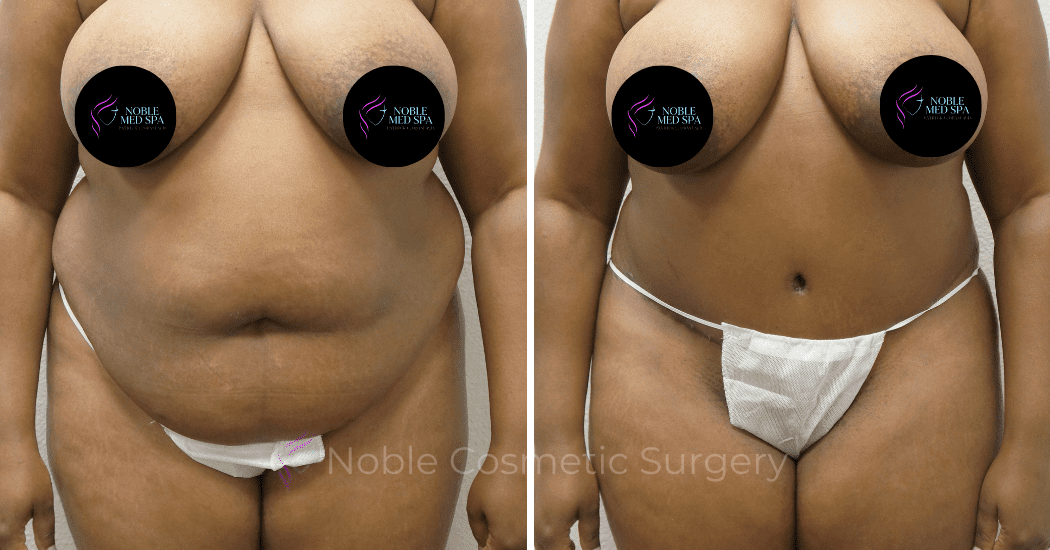 TUMMY-TUCK-CASE-00307 | Before and After Abdominoplasty 1