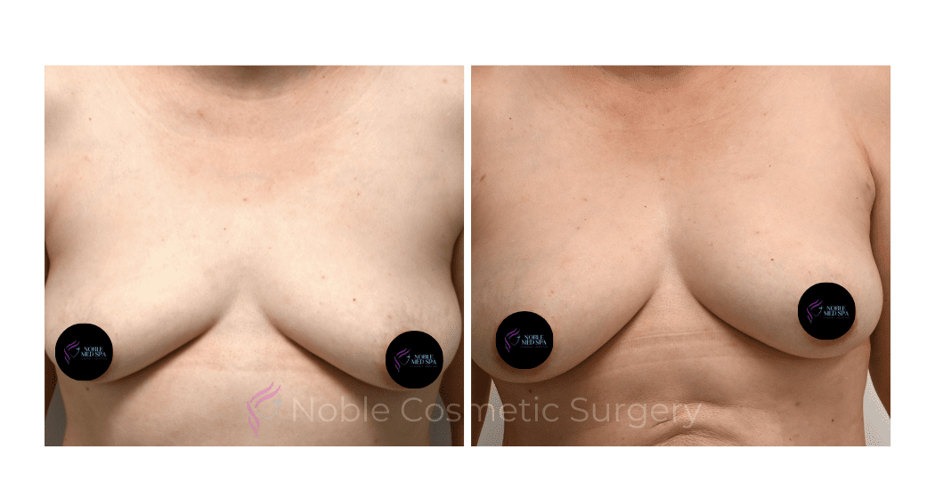 BREAST-AUGUMENTATION-WITH-FAT-TRANSFER-CASE-00260 | Before and After Breast Augmentation