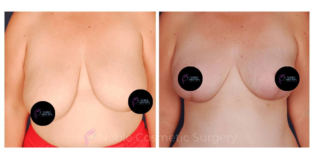 BREAST-REDUCTION-CASE-00224 | Before and After Breast Reduction