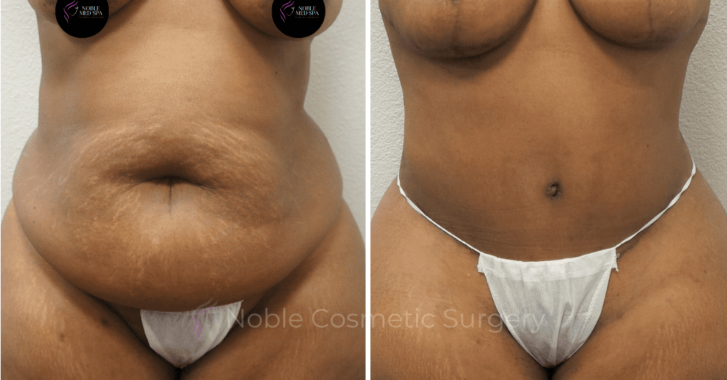 TUMMY-TUCK-CASE-00302 | Before and After Abdominoplasty 1